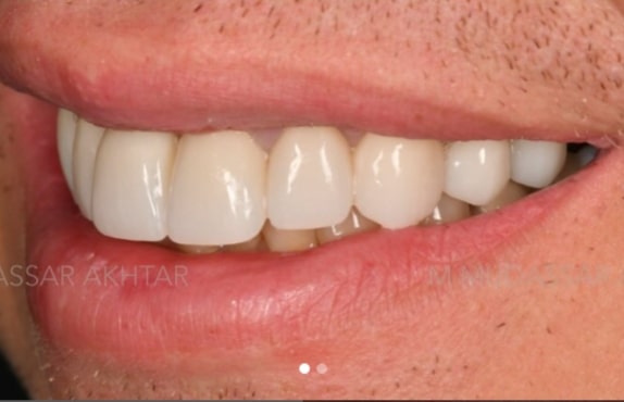 After -Dr Mohammed Mudassar Akhtar