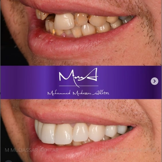 Before - After  Dr Mohammed Mudassar Akhtar