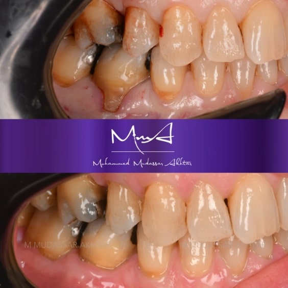 Before - After  Dr Mohammed Mudassar Akhtar