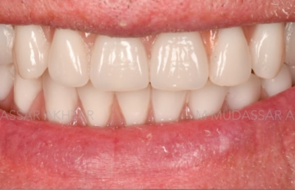 After -Dr Mohammed Mudassar Akhtar