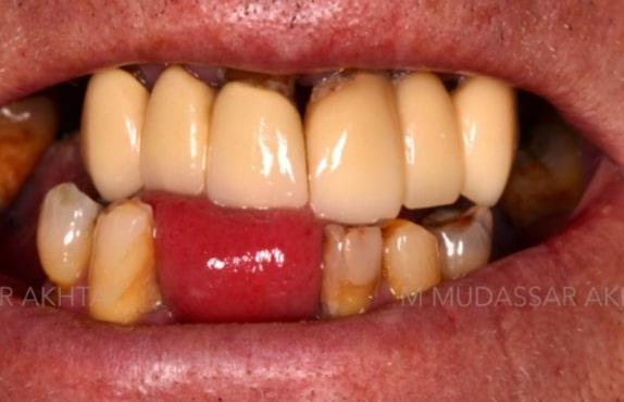 Before - Dr Mohammed Mudassar Akhtar