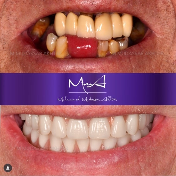 Before - After  Dr Mohammed Mudassar Akhtar