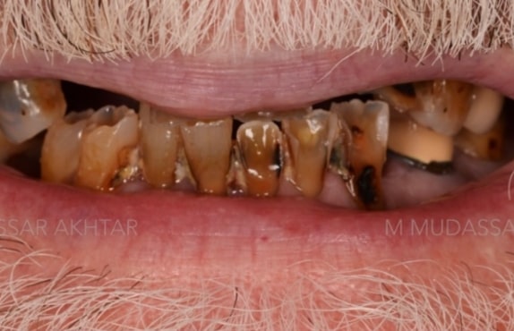 Before - Dr Mohammed Mudassar Akhtar