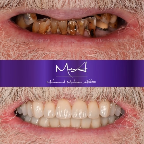 Before - After  Dr Mohammed Mudassar Akhtar