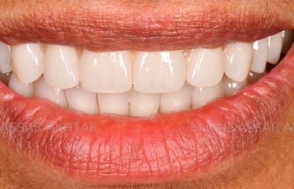 After -Dr Mohammed Mudassar Akhtar