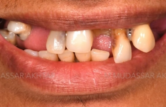 Before - Dr Mohammed Mudassar Akhtar