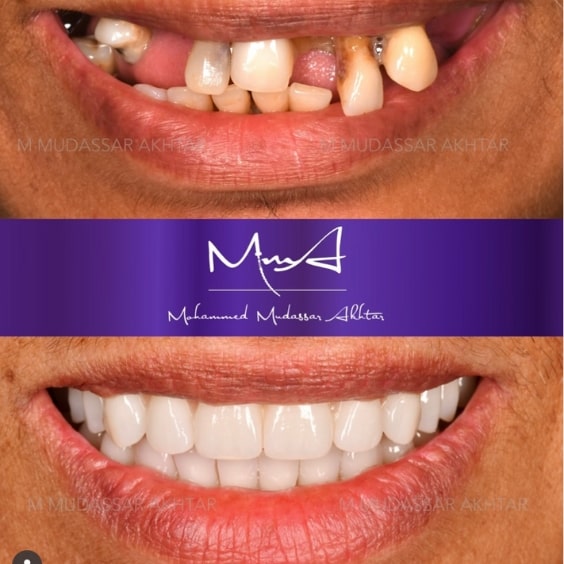 Before - After  Dr Mohammed Mudassar Akhtar